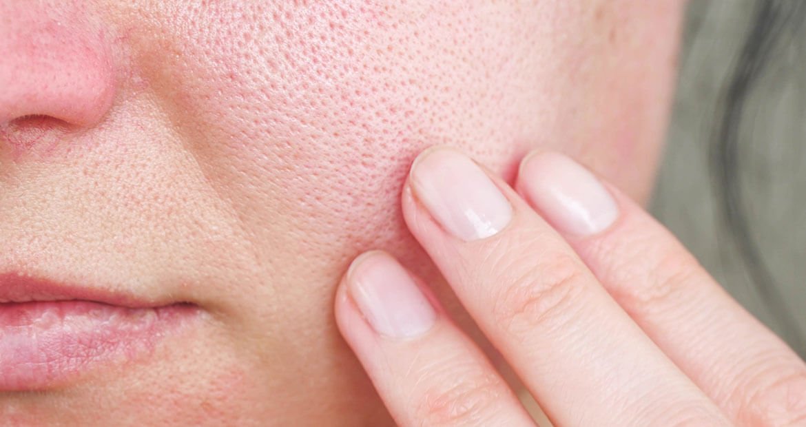 Imagem Poros dilatados: entenda o que são | L'Oréal Paris